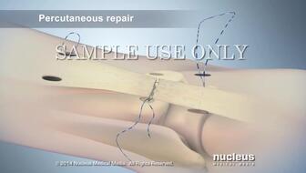 achilles tendon repair post op looks like,Achilles Tendon Repair Post-Op: What to Expect and How It Looks