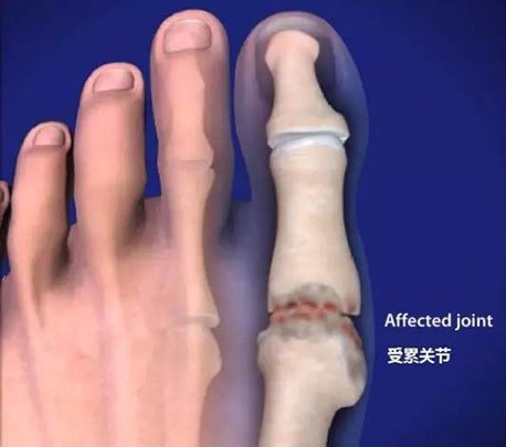 hallux rigidus op,Hallux Rigidus Op: A Comprehensive Guide